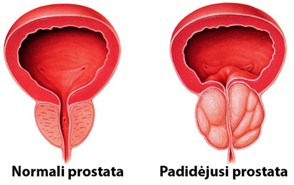 sergant prostatitu yra erekcija bet nėra ejakuliacijos neverta erekcijos