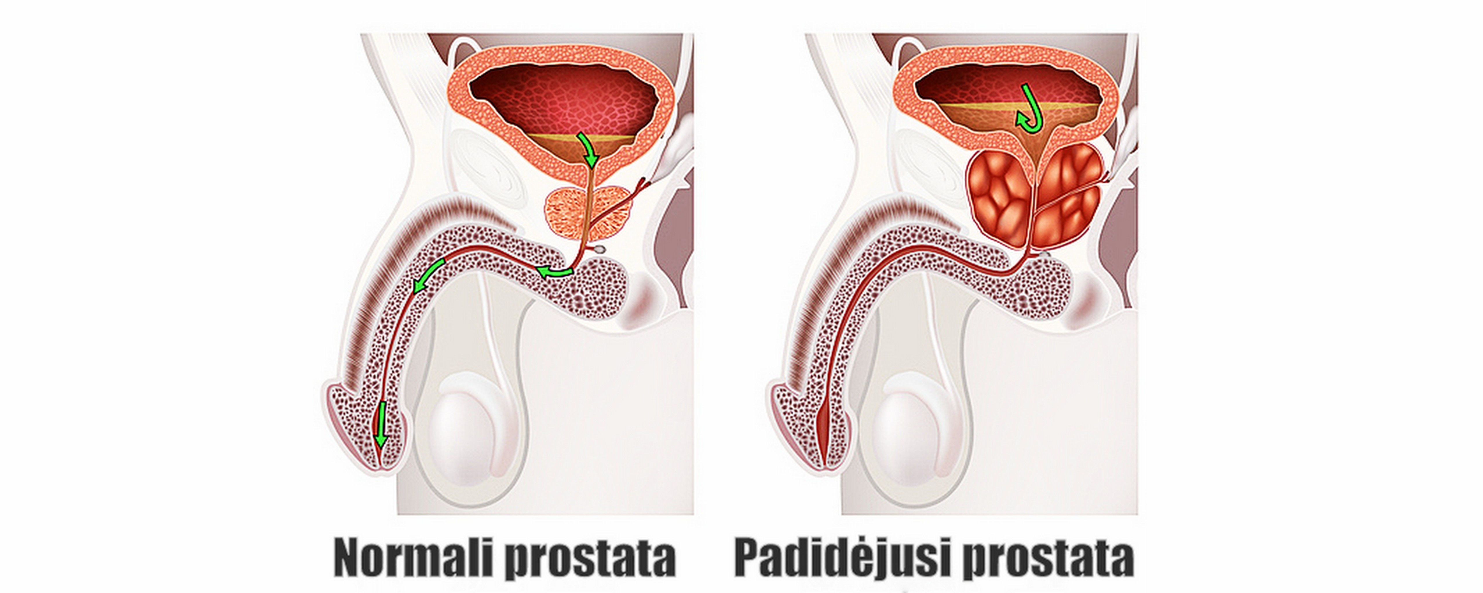 prostatos masažas nėra erekcijos kokia yra erekcijos sumažėjimo priežastis