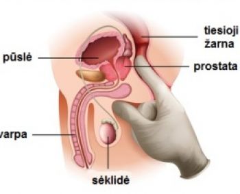 prostatos masažas nėra erekcijos mzhm ir nario dydis