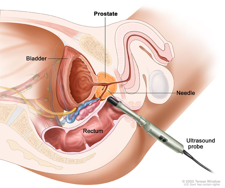 prostatos masažas siekiant sustiprinti erekciją kaip padidinti varpą per mėnesį