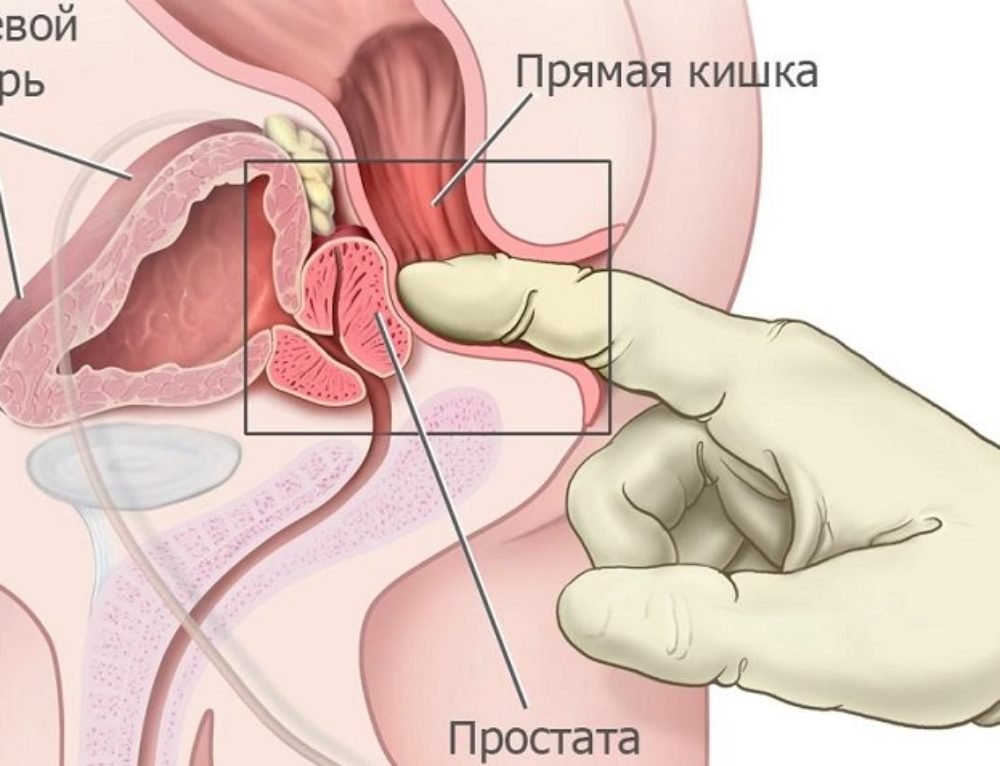 prostatos masažo erekcijos mažinimas erekcijos trūkumas nuo nuovargio